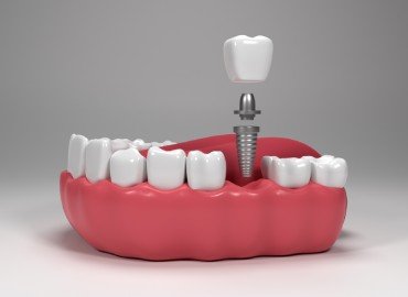 Dental Implant