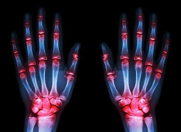 Rheumatoid Arthritis