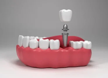 Affordable-Dental-Implant Affordable-Dental-Implant